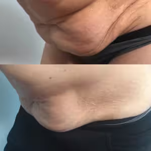 Indiba 3 indiba brzuch