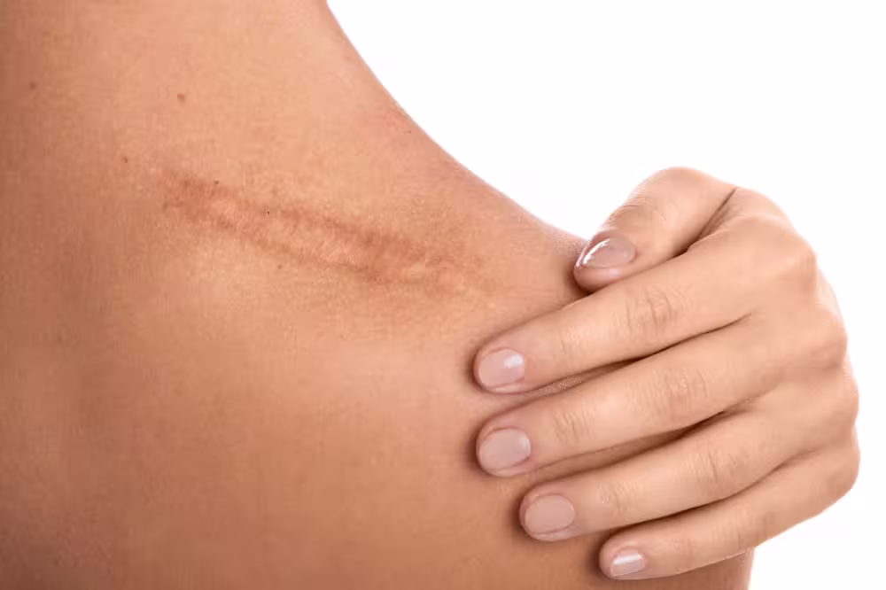 Dermapen 4.0™ – specjalistyczna terapia redukcji blizn 13 dermapern na blizny